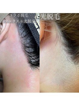 クレオパトラ(CLEOPATRA)/うなじコラボ脱毛と光脱毛の比較
