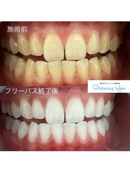 ホワイトニングサロン 熊本店/セルフホワイトニング