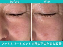 ミスターアンクール 鹿児島(Mr.uncoeur)/フォトトリートメント