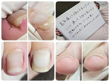 ルナネイル(Luna.Nail)の雰囲気（巻爪メニューございます。まずはご相談ください。）