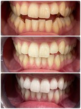 エクシアホワイトニング 日本橋店/ホワイトニングを継続すると