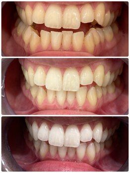 エクシアホワイトニング 日本橋店/ホワイトニングを継続すると