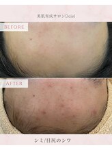 ディシエル(D'ciel)/繰り返すニキビ/肌トラブル