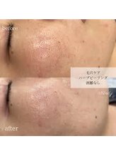 リリーグレース(Lily Grace)/ハーブピーリング(ソフト)