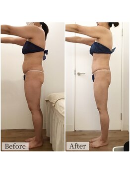 ボーレーヴ(beau reve)/ブライダル/インディバ/痩身