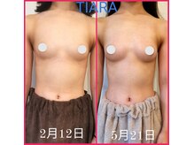 ティアラ(TIARA)の雰囲気（形/大きさ/張り/デコルテ/自信あるバストへ！症例はインスタへ★）