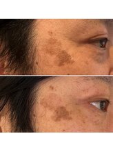 ルーメ(lume)/シミケア40代男性