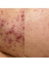 メンズサロンエヌエー(MEN'S SALON NA)/ニキビケア専用ホームケア