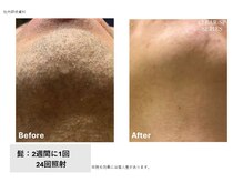 ラッシュ(RUSH)/カミソリ負け→ツルツルに！