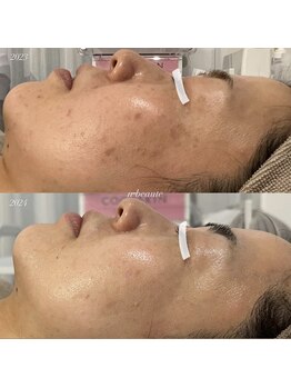 エヌボーテ(n beaute)/HERMOSA/ハーブピーリング