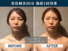 シンク(CINQ)/美容鍼灸90分むくみ改善小顔効果