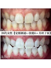 ホワイト 福岡天神店(WHITE)/ホワイトニングビフォーアフター