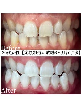 ホワイト 福岡天神店(WHITE)/ホワイトニングビフォーアフター