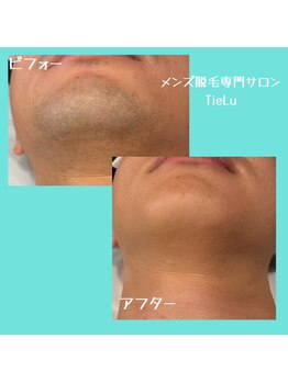 ティエル(TieLu)の写真/青ヒゲ・濃いヒゲにお悩みの方へ☆毎朝のヒゲ剃りをもっとラクに！