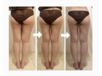 美人バスト つくば店/【脚 症例】