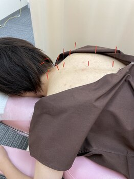 すみだバランス鍼灸整骨院 押上本院/肩こり・背中の張りに鍼コース