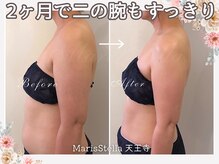 マリスステラ 天王寺(MarisStella)/二の腕の変化【天王寺エステ】