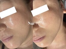 リベルテ(Liberte)/リフトケア