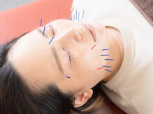 けいのき鍼灸整骨院/施術風景＊美容鍼/美容鍼灸/小顔