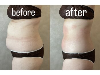 ナルシス(Narcissus)/インディバで内臓脂肪減少