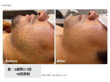 ラッシュ(RUSH)/8ヶ月でヒゲ脱毛完了！