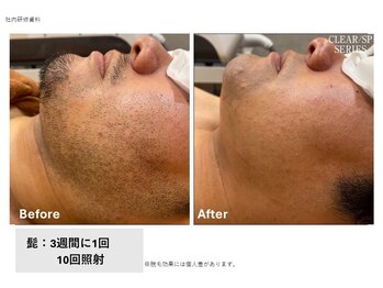 ラッシュ(RUSH)/8ヶ月でヒゲ脱毛完了!
