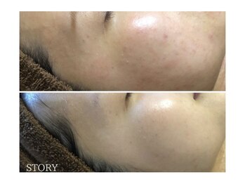 ストーリー 岐阜店(STORY)/ハーブピーリング専門店STORY