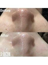 ミラン(MiLaN)/毛穴洗浄ハイドラヴィーナス