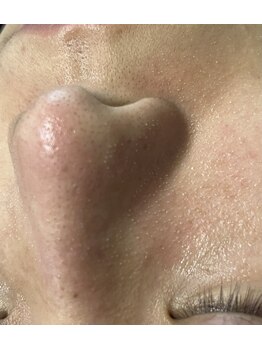 ビーカーブス 三鷹(B.curves)/毛穴汚れ