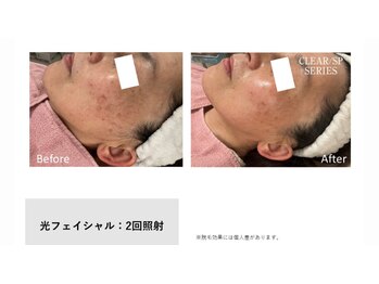 サロン ルアナ(salon luana)/光フェイシャル　before→after