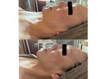 ラローゼ トウキョウ(LA ROSEE TOKYO)の雰囲気（ヒト幹細胞培養液導入ケア、リフトアップ、美白、引き締め◎）