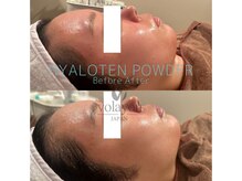 クレセント(crescent)/”乾燥肌”なら水分爆弾管理