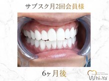 ホワイヤ セルフホワイトニング DBS神楽坂(Whi-Ya)/☆サブスク会員様☆納得の白さ☆
