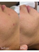 サロンナナジュウニ(Salon72)/ニキビ/毛穴