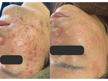 デン(DEN)の写真/プラズマニア/美肌光フェイシャル/毛穴洗浄でお肌悩みに◎ニキビケア/シミしわ・たるみ・毛穴・くすみ改善!