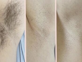 ベアスキン 恵比寿店(BARE SKIN)/脇脱毛照射前後