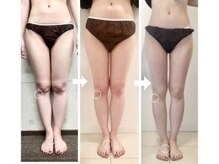 美人バスト つくば店/【脚　症例】