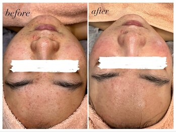 ねね整骨院 エヌシャープ(N#)/気になるニキビにアプローチ!