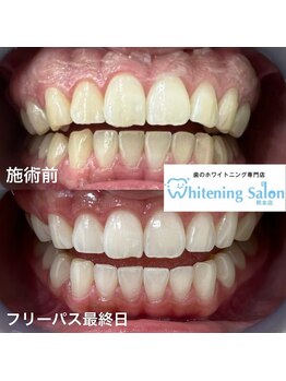 ホワイトニングサロン 熊本店/人気のセルフホワイトニンング