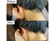 ビマナ 小岩店(NU美Mana)/【Men'sうなじ脱毛】