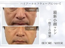 ユアーズ ビューティー(YOURS beauty)/小顔と一緒にシミケアを☆