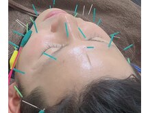 青葉台駅前整骨院/美容鍼は男性の方も施術可能です