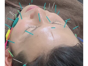 青葉台駅前整骨院/美容鍼は男性の方も施術可能です