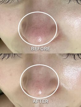サロンドジェシカ(salon de Jessica)/プラズマフェイシャル