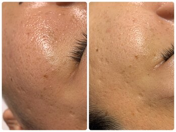 ロメリア(Roemeria)/お客様BeforeAfter