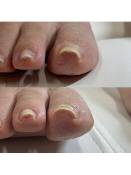 リリ(lili)/巻き爪矯正/2回目