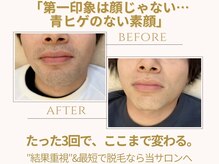 メンズ脱毛得意☆女性目線のアドバイスやご相談も大歓迎♪