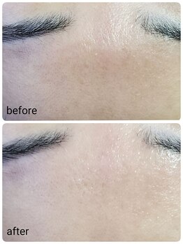 シャルマン/おでこ黒ずみ明るい肌へ