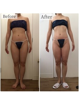 ボーレーヴ(beau reve)/ブライダル/インディバ/痩身