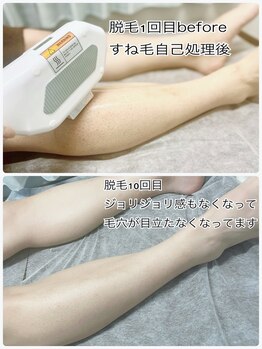 エンチャント(ENCHANT)/メンズ脱毛